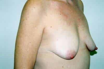 Breast Lift