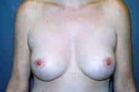 Breast Lift