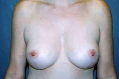 Breast Lift