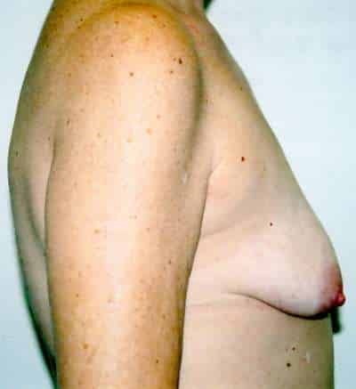 Breast Lift