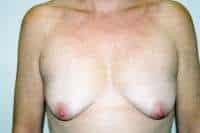 Breast Lift