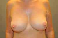 Breast Lift