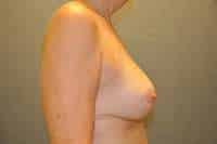 Breast Lift