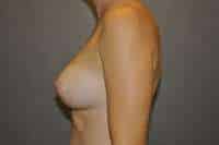Breast Augmentation