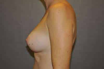 Breast Augmentation