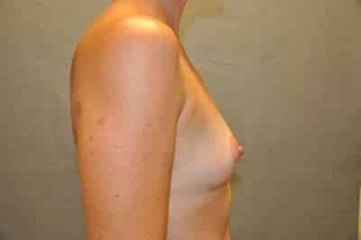 Breast Augmentation