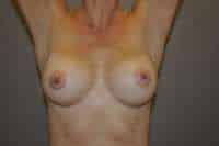 Breast Augmentation