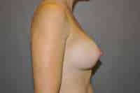 Breast Augmentation