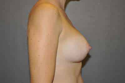 Breast Augmentation