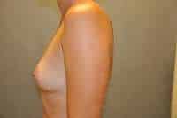 Breast Augmentation