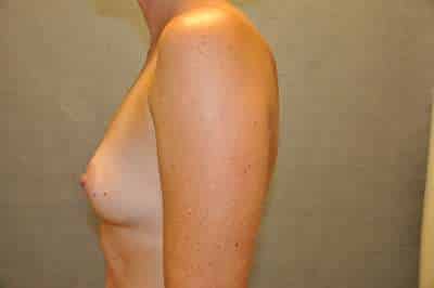 Breast Augmentation