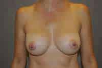 Breast Augmentation