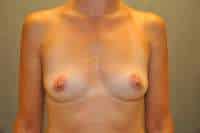 Breast Augmentation