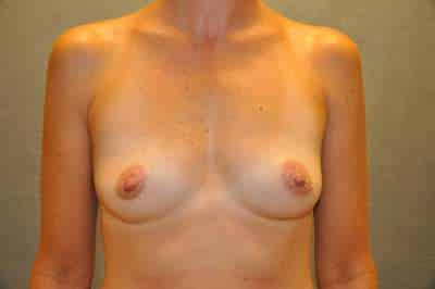 Breast Augmentation