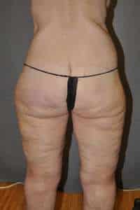 Belt Lipectomy