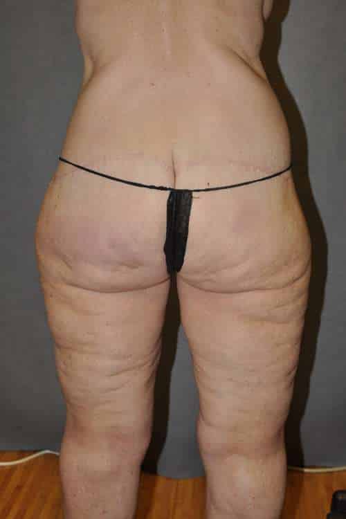 Belt Lipectomy