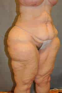 Belt Lipectomy