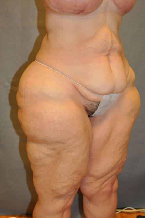 Belt Lipectomy