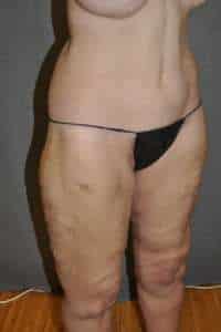 Belt Lipectomy