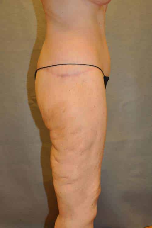 Belt Lipectomy