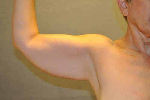 Arm Lift