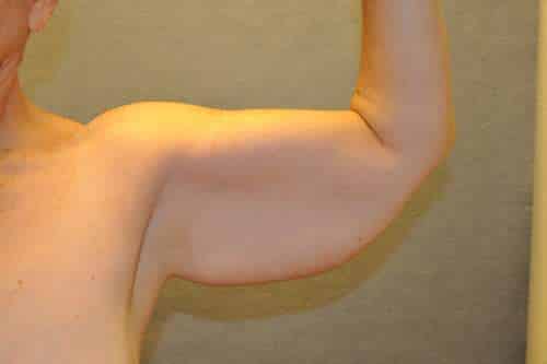 Arm Lift