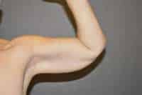Arm Lift