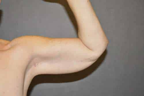 Arm Lift