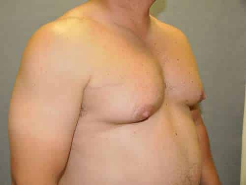male breast reduction