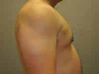 Gynecomastia