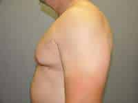 Gynecomastia