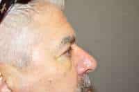 Male Eyelid Lift