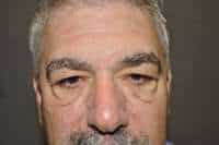 Male Eyelid Lift
