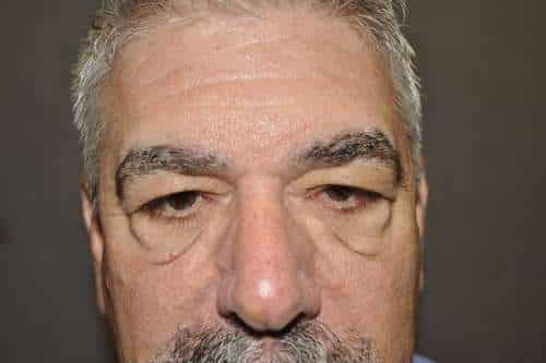 Male Eyelid Lift