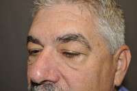 Male Eyelid Lift