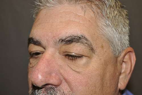 Male Eyelid Lift