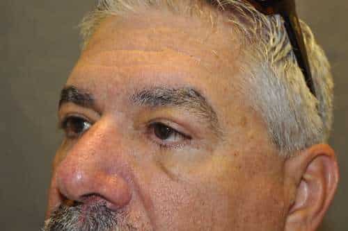 Male Eyelid Lift