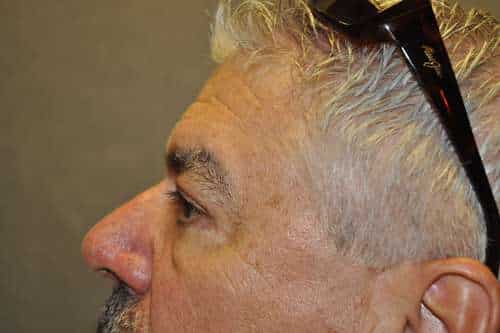 Male Eyelid Lift