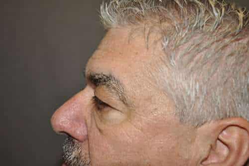 Male Eyelid Lift