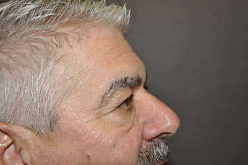 Male Eyelid Lift