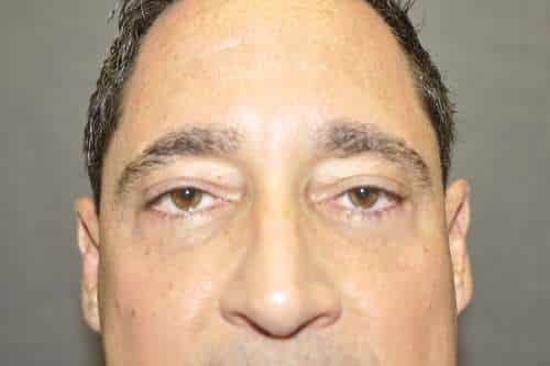 Male Eyelid Lift