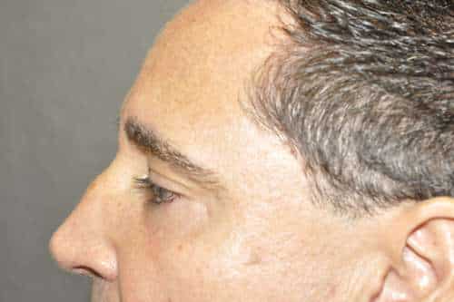 Male Eyelid Lift