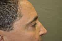 Male Eyelid Lift