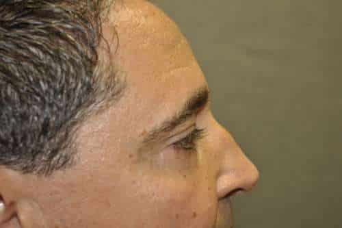 Male Eyelid Lift