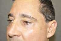 Male Eyelid Lift