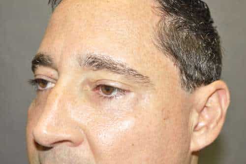 Male Eyelid Lift