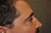Male Eyelid Lift