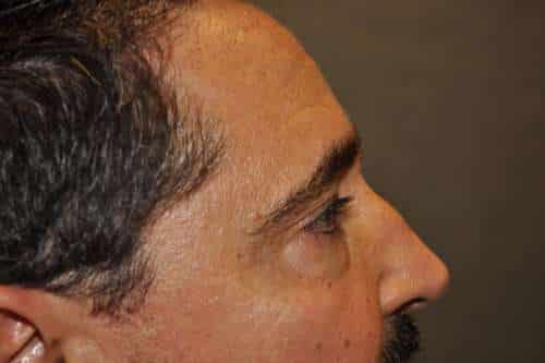 Male Eyelid Lift
