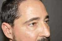 Male Eyelid Lift