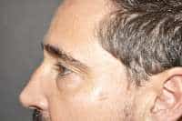 Male Eyelid Lift